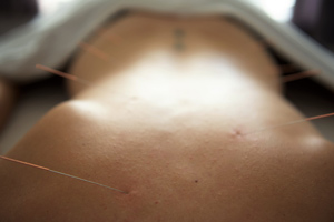 acupuncture